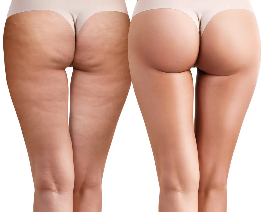 Read about cellulite Folkestone: causes, treatments, and debunked myths